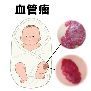 <strong>血管瘤不及时治疗会怎么样？南京胎记医生哪里好点？</strong>