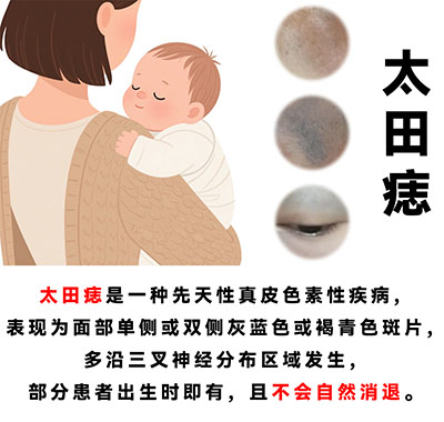 太田痣会有哪些危害？南京胎记医院哪家好？