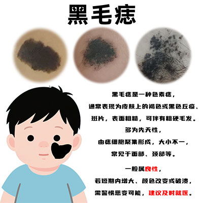 黑毛痣是否可以提前预防？南京胎记医院排名